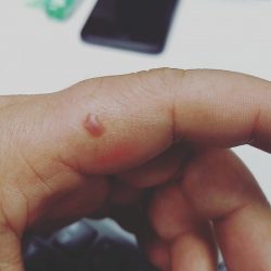 手经常痒痒，抓啊抓就起些小泡泡，不知道是什么原因，有人说是血热，不懂。